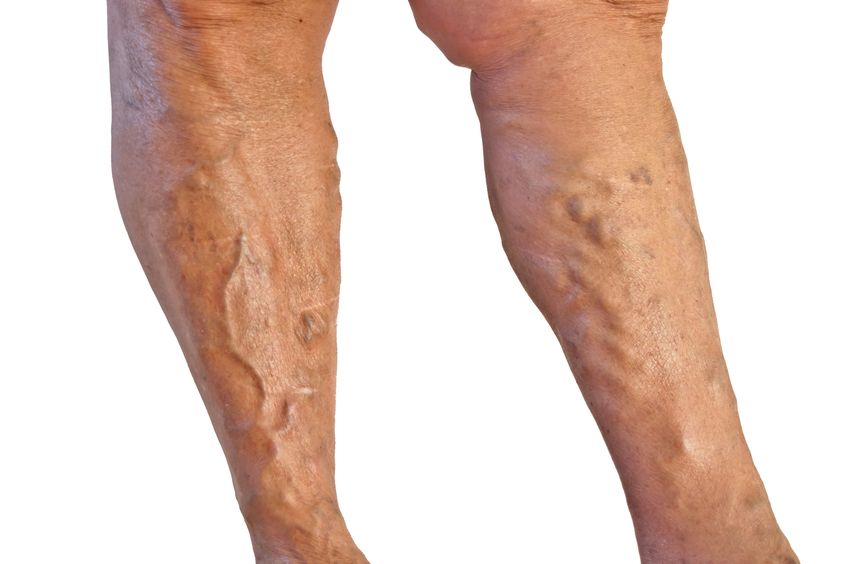 Find Relief Faster with Expert Varicose Veins Treatment