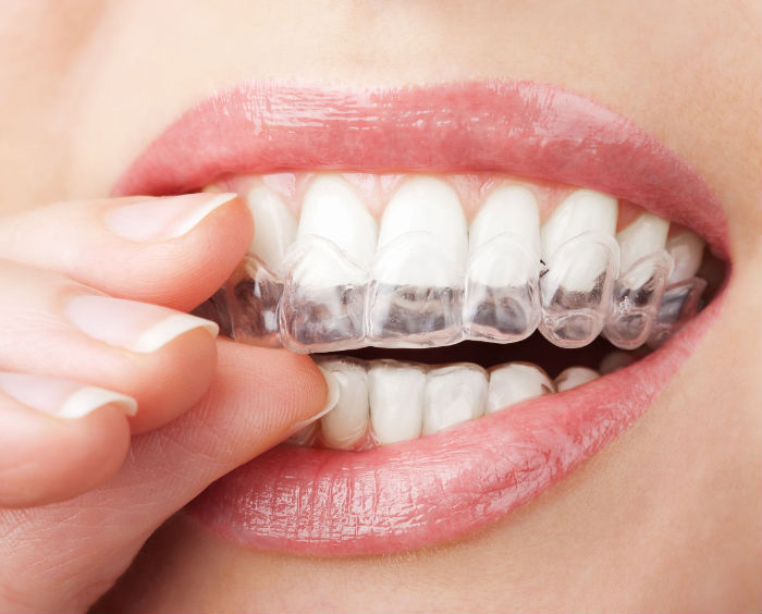 How to Find a Dental Implant Provider in the Chicago Area