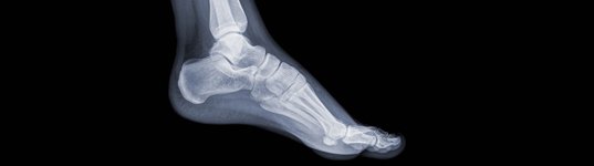 Find the Most Effective Flat Foot Treatment in Racine, WI Today