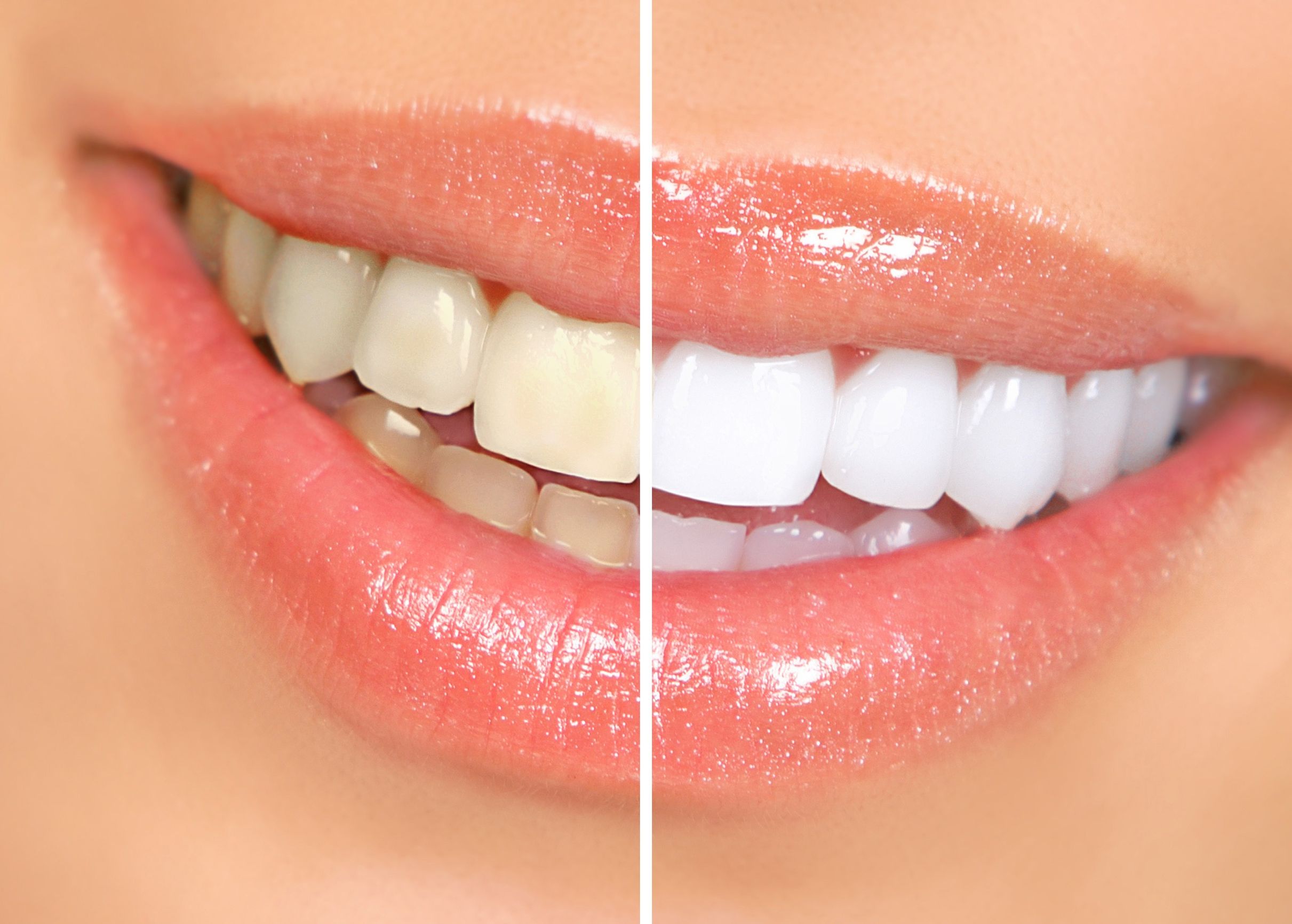 How To Achieve Teeth Whitening in HI