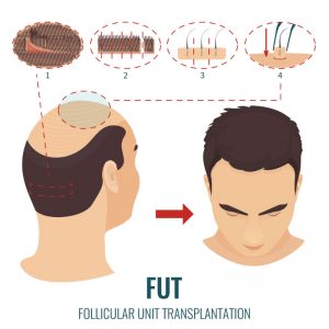 Find Out If Hair Restoration in New York City Is Right for You