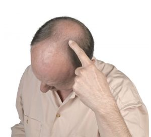 The Main Factor That Makes You a Candidate for Connecticut Hair Restoration