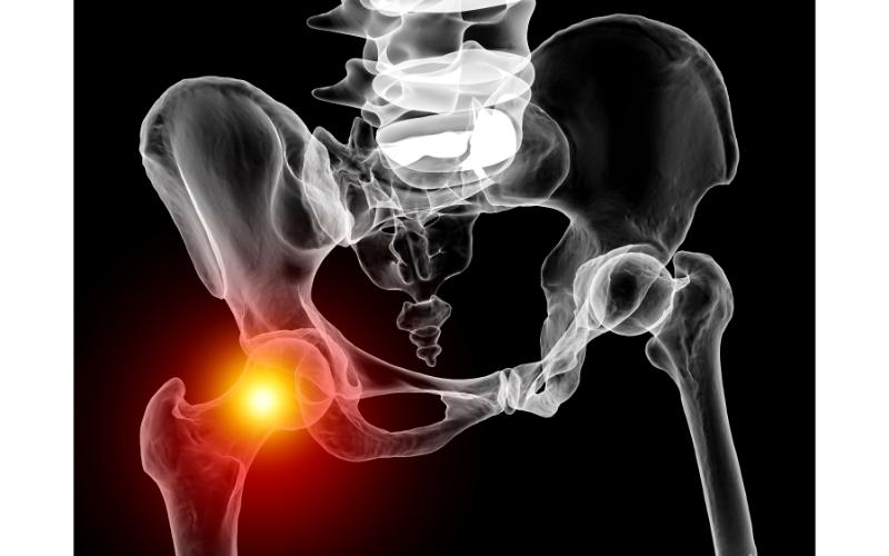 Is It Better to Rest or Exercise When Experiencing Hip Pain in San Diego?