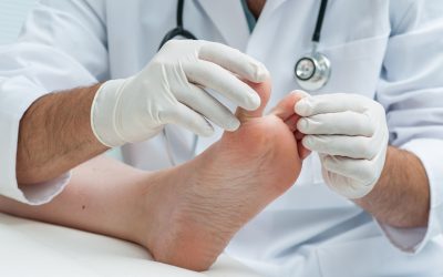 When Is It Time to See a Bunion Doctor? 5 Warning Signs You Shouldn’t Ignore