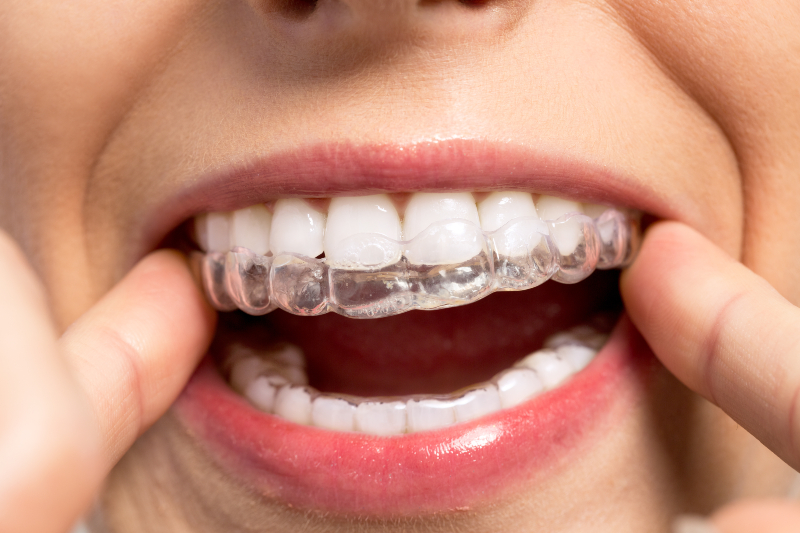 Straighten Your Smile Confidently with Invisalign Deerfield IL Clear Aligner Solutions