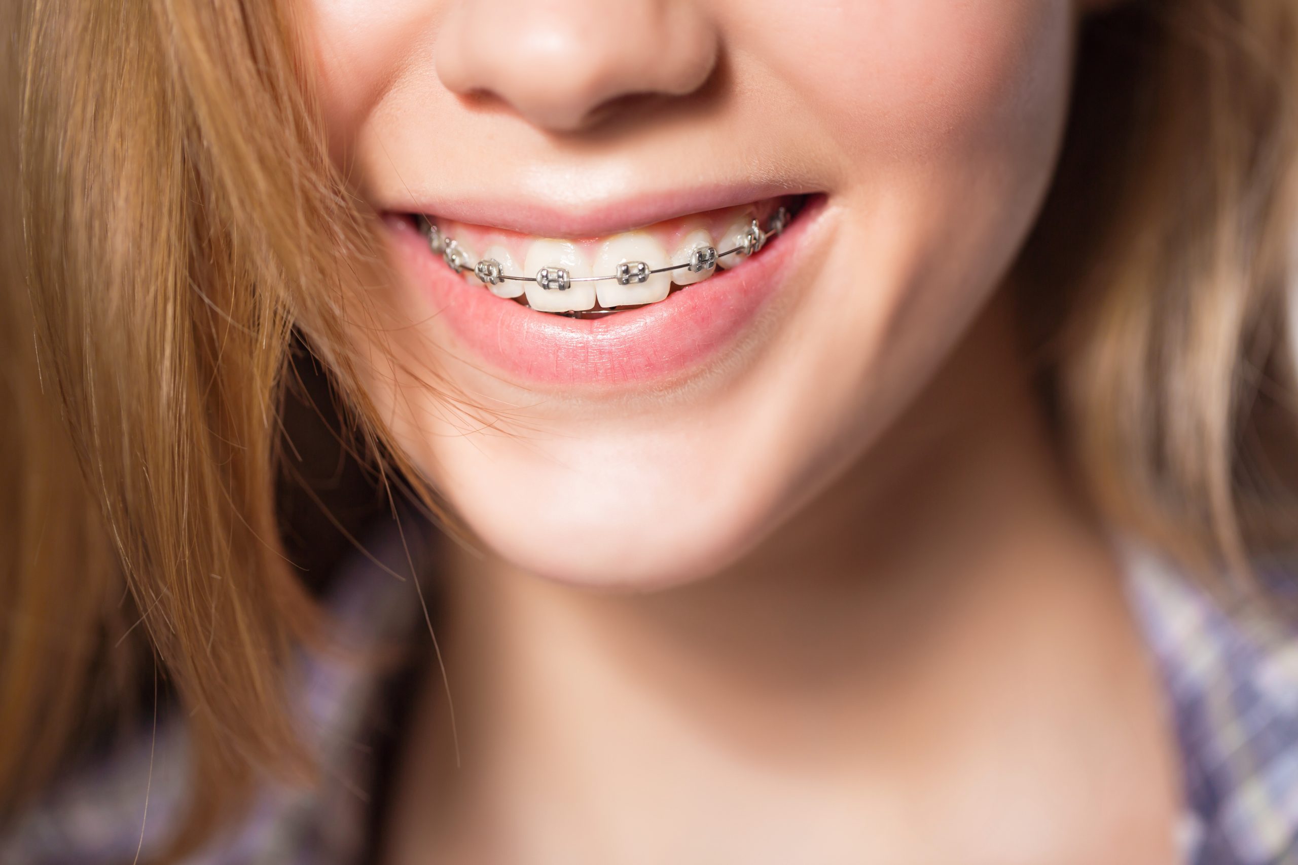 Transform Your Smile With Clear Aligners Metairie Residents Trust for Comfort and Results