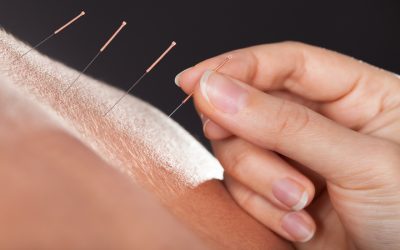 Experience Lasting Calm with Acupuncture For Stress Bellingham WA Residents Trust Most