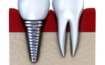 Lasting Tooth Replacement Solutions Available Through Implant Dentistry Louisville