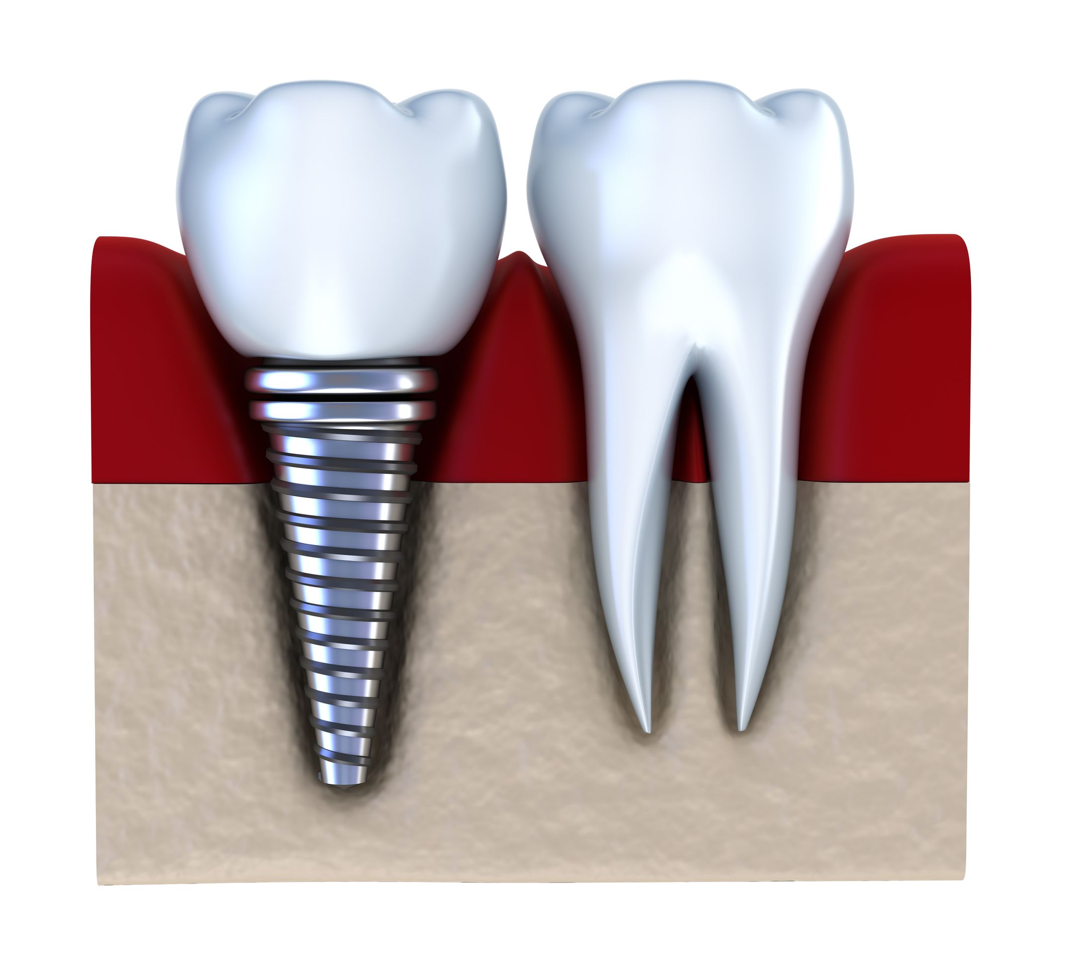 Lasting Tooth Replacement Solutions Available Through Implant Dentistry Louisville