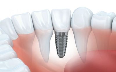 Regain Your Confident Smile With Dental Implants in Isle Of Palms Sc Today